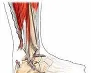 دانلود pdf مقاله  التهاب و پارگی تاندون آشیل رایگان