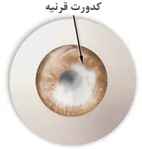 دانلود pdf مقاله  پیرامون آب مروارید و درمان آن رایگان