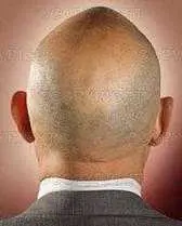 دانلود pdf کتاب کاشت موی طبیعی دکتر علی وفائی رایگان