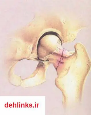 دانلود pdf کتاب پوکی استخوان